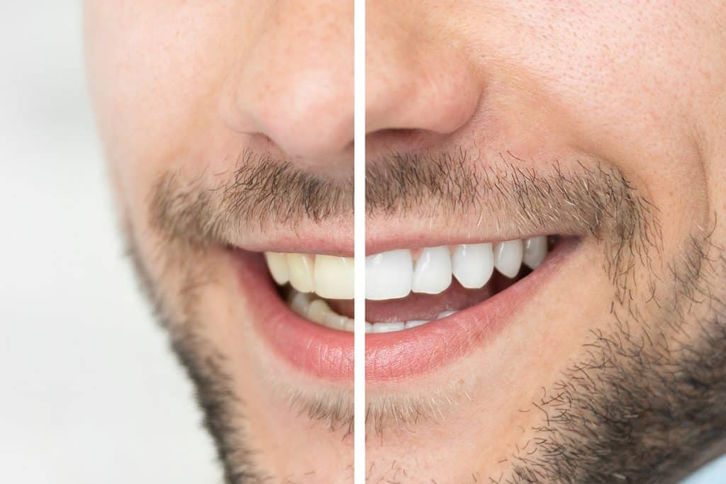 3 Options for Whitening Your Teeth