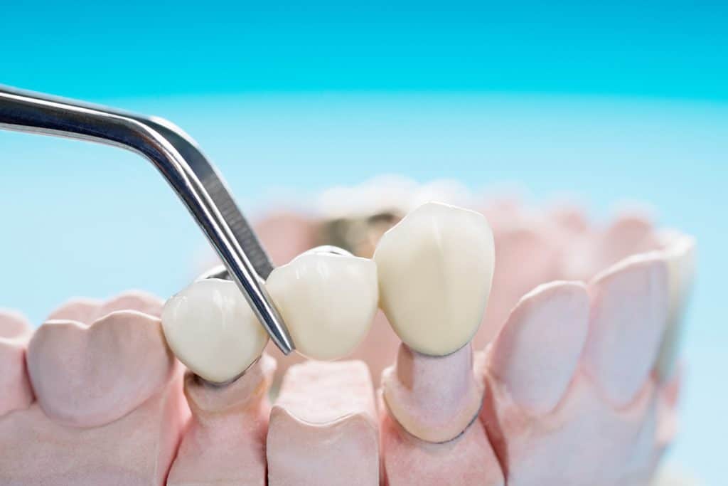 How Long Do Dental Bridges Last?