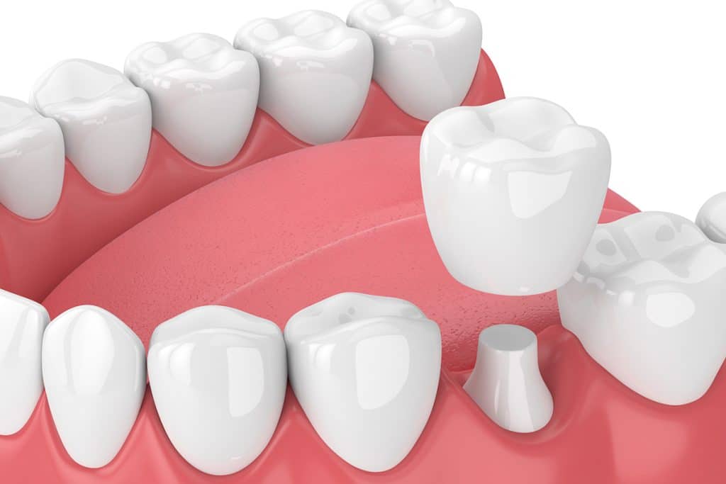 The Importance of Dental Crowns for Teeth with Fillings